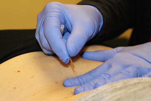 Elkins Physical Therapy offers trigger point dry needling for pain relief in Elkins, WV